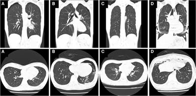 Diverse clinical presentation of primary spontaneous pneumothorax in patients with pectus excavatum